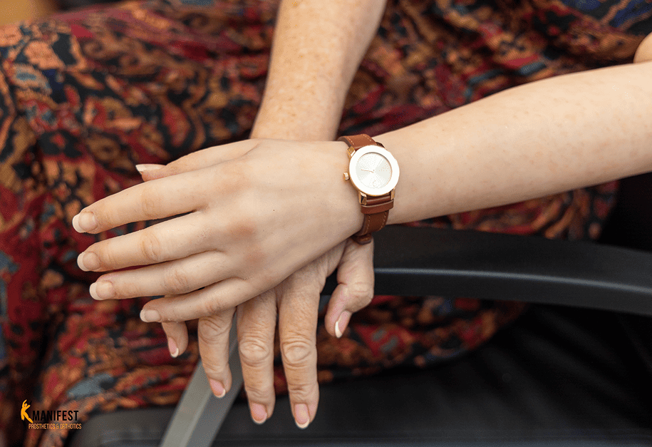 Patient wearing a silicone hand restoration with a wristwatch.